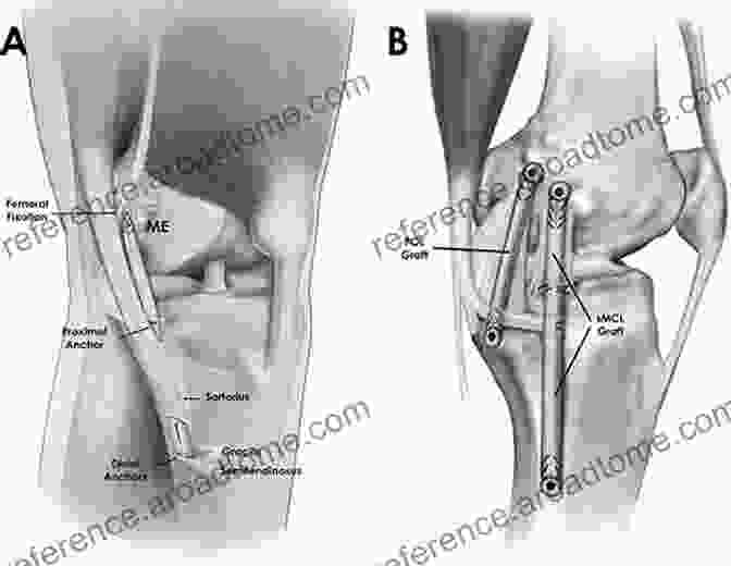 Advanced Knee Reconstruction Surgical Technique Knee Surgery: Tricks Of The Trade