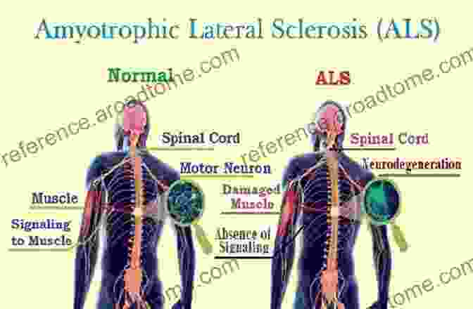 Diagram Illustrating Potential Causes Of Amyotrophic Lateral Sclerosis (ALS) Amyotrophic Lateral Sclerosis Richard A Driscoll O D