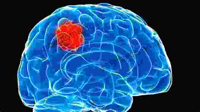 Glioma A Brain Tumor Characterized By Abnormal Cell Growth. Brainlesion: Glioma Multiple Sclerosis Stroke And Traumatic Brain Injuries: 5th International Workshop BrainLes 2024 Held In Conjunction With MICCAI Notes In Computer Science 11992)