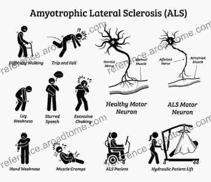 Image Depicting Common Symptoms Of Amyotrophic Lateral Sclerosis (ALS) Amyotrophic Lateral Sclerosis Richard A Driscoll O D