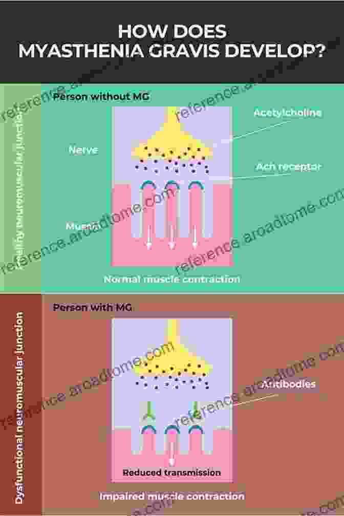 Ion Channels And Myasthenia Gravis Ion Channel Diseases (ISSN 63)