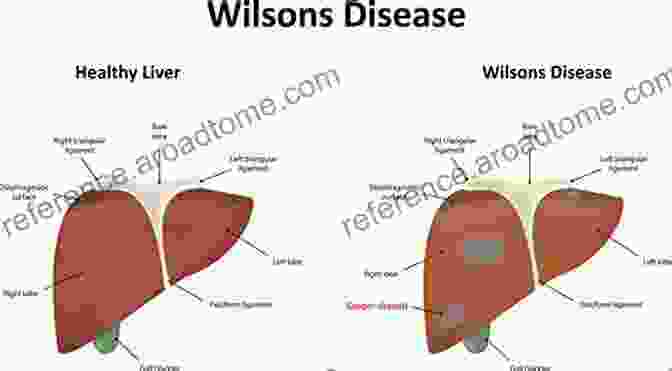 Liver Damage Caused By Wilson Disease Wilson S Disease : Rare Genetic DisFree Download