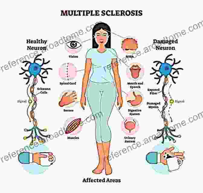 Multiple Sclerosis An Autoimmune Disease Damaging The Myelin Sheath. Brainlesion: Glioma Multiple Sclerosis Stroke And Traumatic Brain Injuries: 5th International Workshop BrainLes 2024 Held In Conjunction With MICCAI Notes In Computer Science 11992)