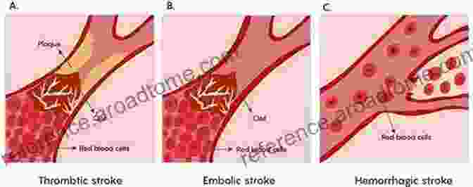 Stroke A Sudden Loss Of Blood Flow To The Brain. Brainlesion: Glioma Multiple Sclerosis Stroke And Traumatic Brain Injuries: 5th International Workshop BrainLes 2024 Held In Conjunction With MICCAI Notes In Computer Science 11992)