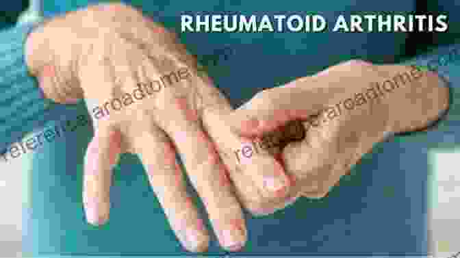 Understanding Rheumatoid Arthritis By Madhuri Reddy Understanding Rheumatoid Arthritis Madhuri Reddy