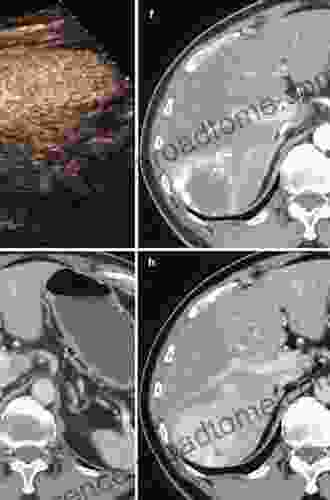 Benign Tumors of the Liver