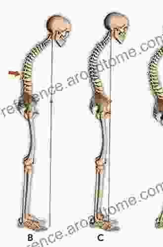 Sagittal Balance Of The Spine: From Normal To Pathology: A Key For Treatment Strategy