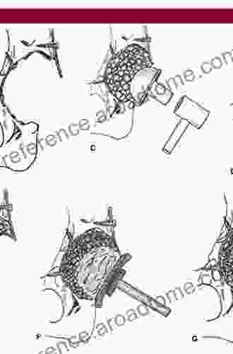 Impaction Bone Grafting In Revision Arthroplasty