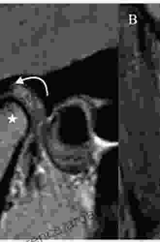 MRI Of The Temporomandibular Joint: Correlation Between Imaging And Pathology