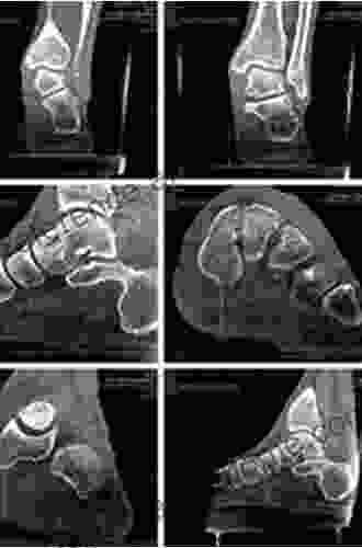 Weight Bearing Cone Beam Computed Tomography (WBCT) In The Foot And Ankle: A Scientific Technical And Clinical Guide